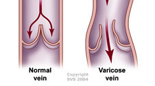 New Varicose Vein Registry Launched